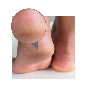 GOLMAR- Crema Talloni Screpolati Extra Idratante 40% Urea GolmarDerm 100ml