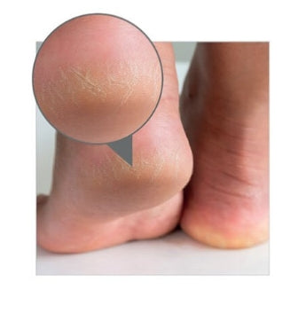 GOLMAR- Crema Talloni Screpolati Extra Idratante 40% Urea GolmarDerm 100ml